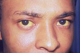 Delapan Obat Alami untuk Mengobati Penyakit Kuning