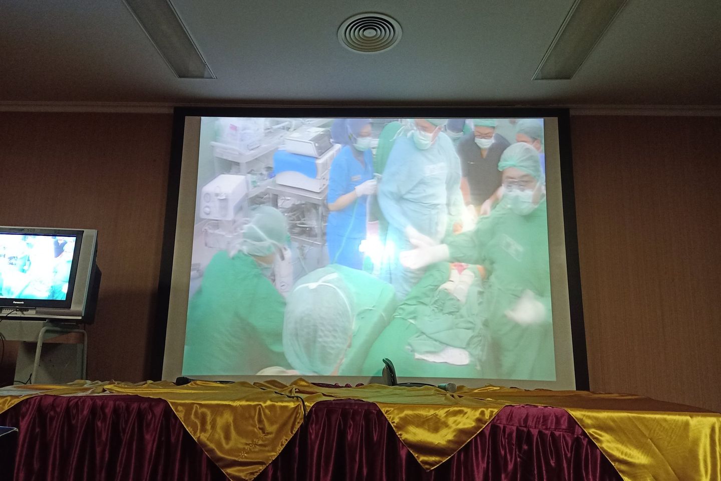 Operasi Pemisahan Bayi Kembar Selesai, Tim Dokter Pasang Pelat di Dada Azila