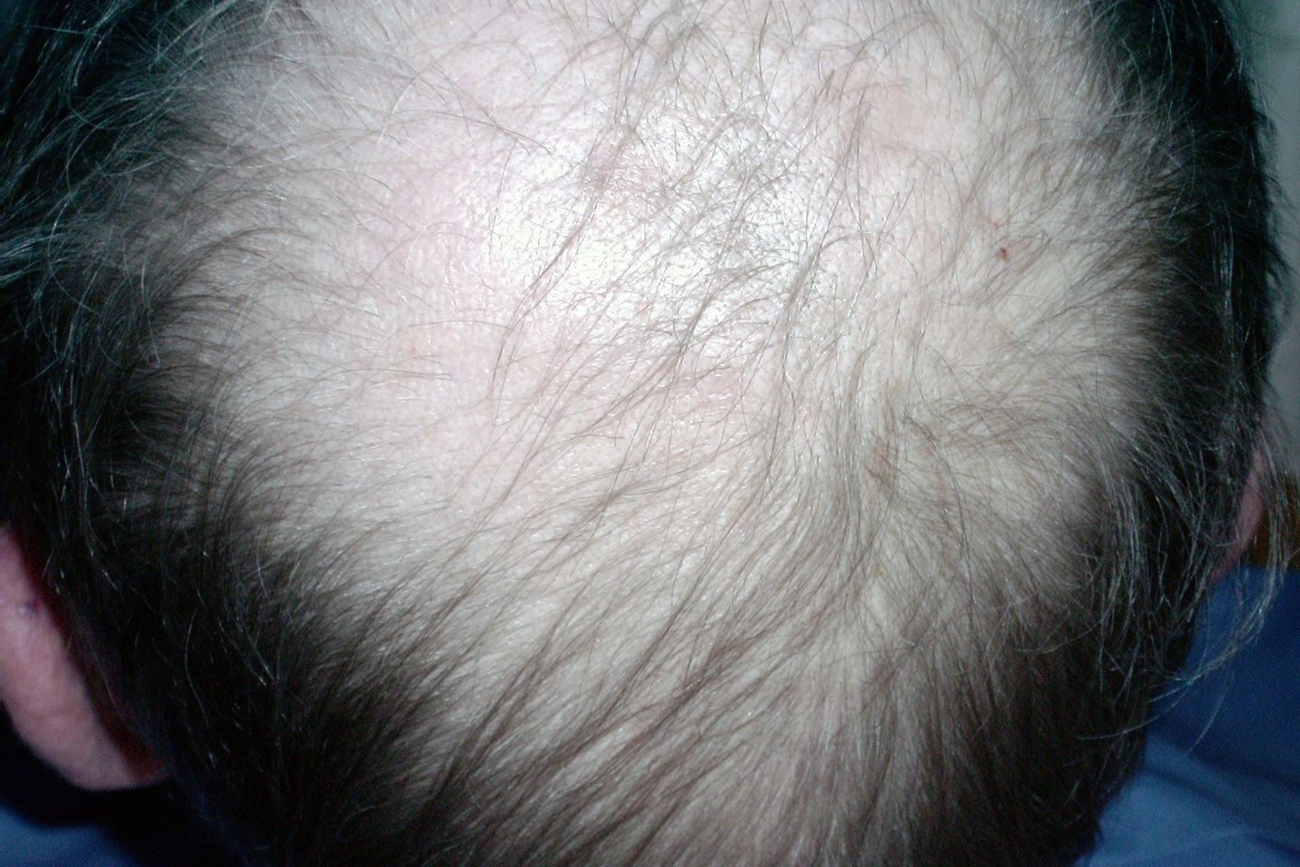 Mengenal Jenis-jenis Rambut Rontok dan Perawatannya