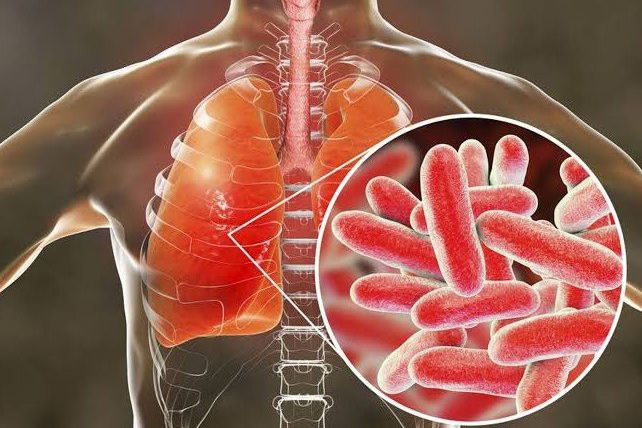 Pemkot Surabaya Keluarkan SE Kewaspadaan Terhadap Penyakit Legionellosis