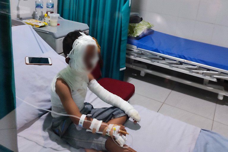 Diduga Usai Makan Es Smoket, Anak di Ponorogo Harus Menderita Luka Bakar