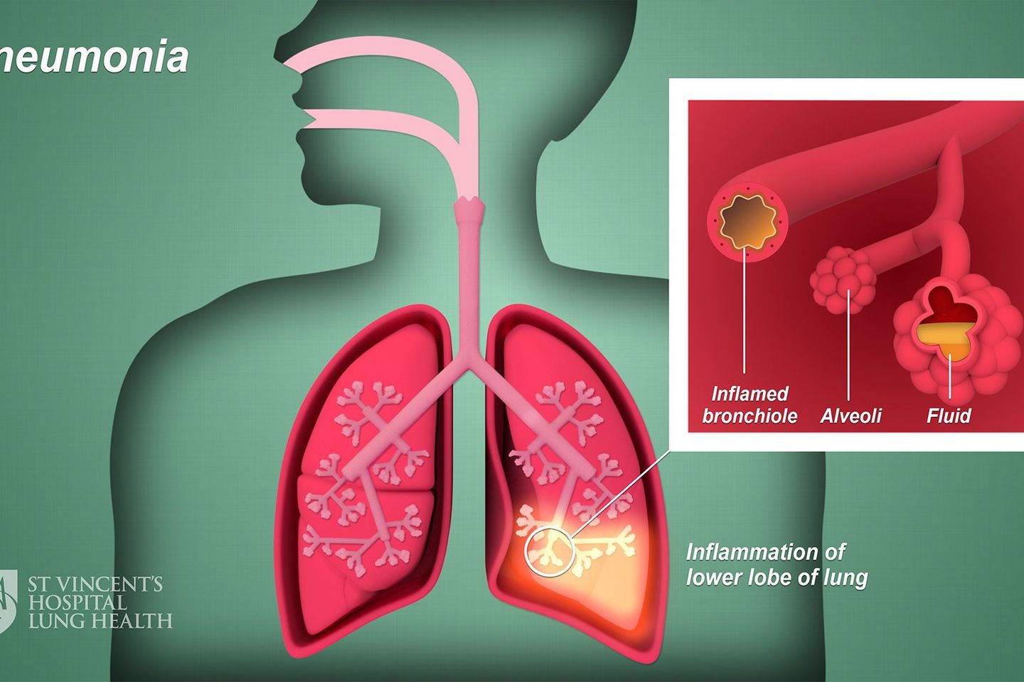 Peran Ayah Penting Cegah Pneumonia