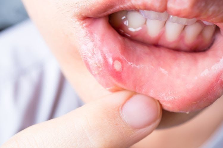 Ini 4 Obat Sariawan dari Bahan Rumahan