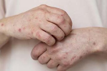 Kasus Campak Merebak, Khofifah Instruksikan Lengkapi Vaksin Campak Rubella Anak
