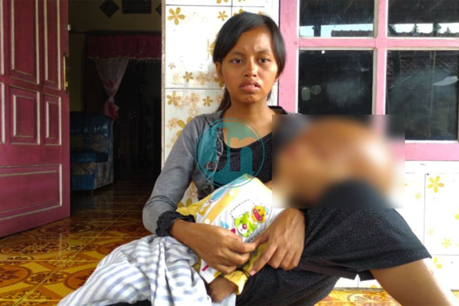 Tidak Ada Perhatian Pemerintah dan Terkendala Biaya, Batita di Mojokerto Alami Hidrosefalus