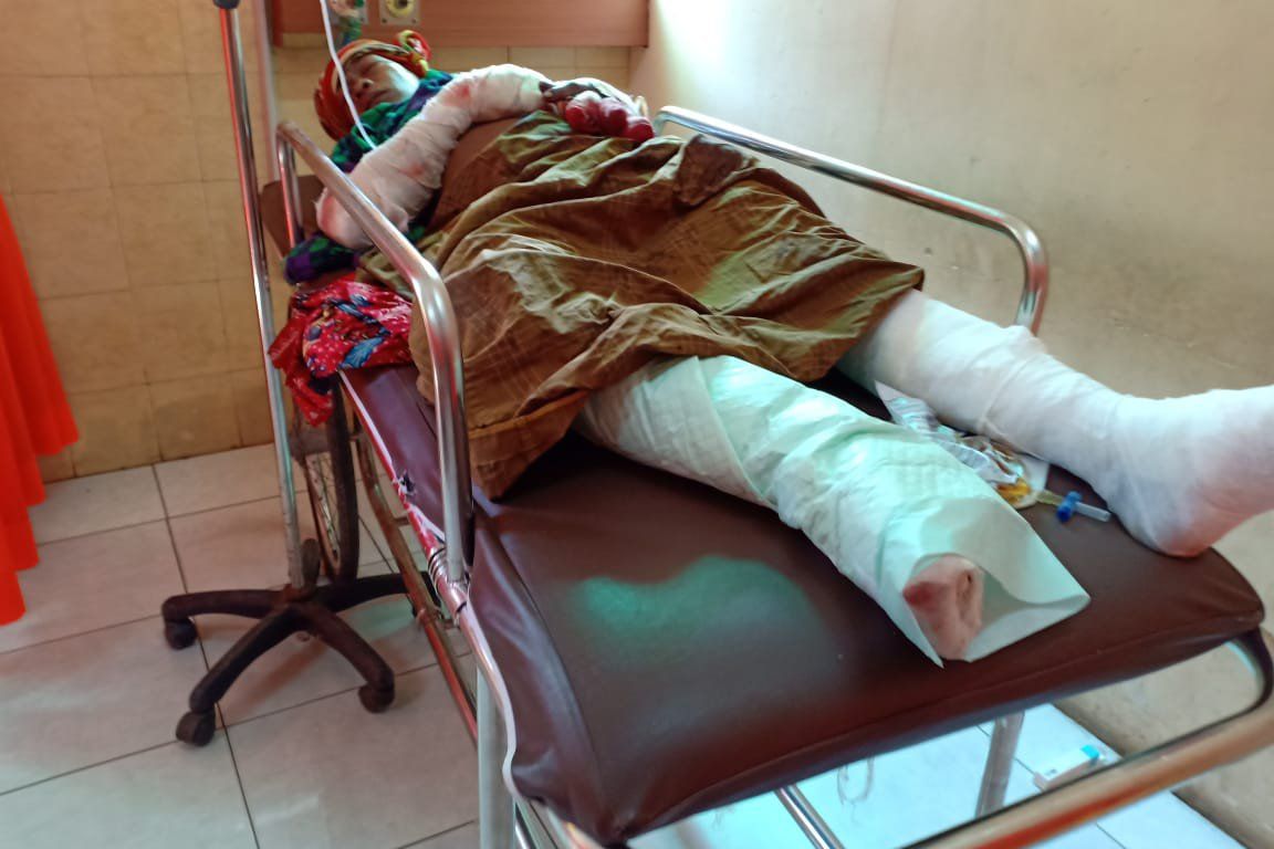 Korban Ledakan Petasan Probolinggo Alami Luka Bakar 33 Persen