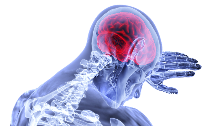 Stroke Juga Rentan Sasar Usia Muda