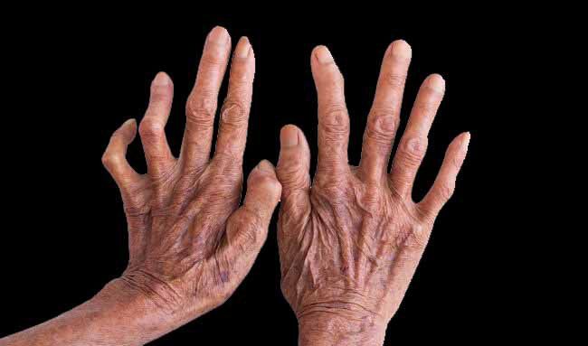 Indonesia Penyumbang Kusta Ketiga di Dunia