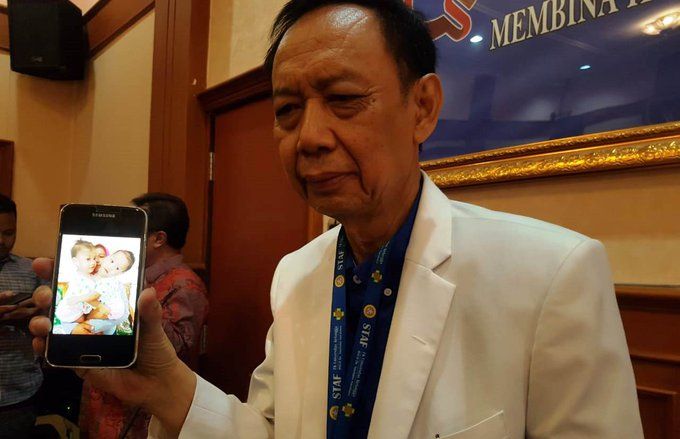 RSUD dr Soetomo Tangani Bayi Kembar Siam dari Kendari