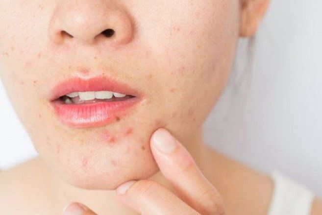 Ini Masalah Kulit yang Sering Terjadi akibat Pemakaian Masker