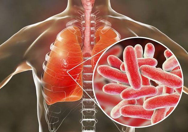 Pemkot Surabaya Keluarkan SE Kewaspadaan Terhadap Penyakit Legionellosis