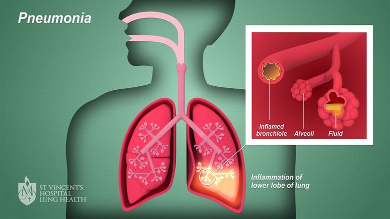 Peran Ayah Penting Cegah Pneumonia
