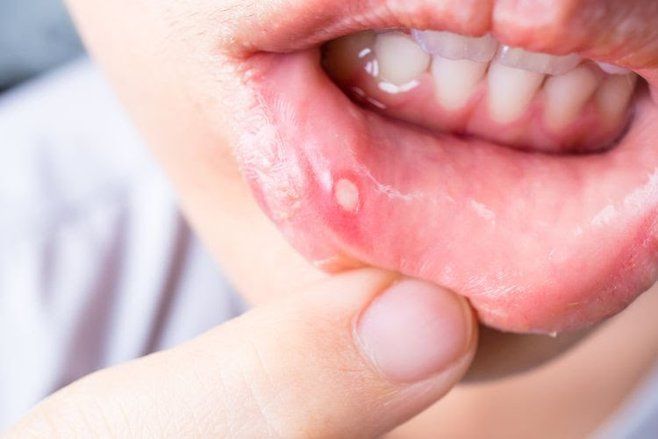 Ini 4 Obat Sariawan dari Bahan Rumahan