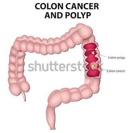 Begini Tanda-Tanda Kanker Usus