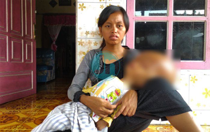 Berikut Penjelasan Dinkes Soal Batita di Mojokerto Kena Hidrosefalus