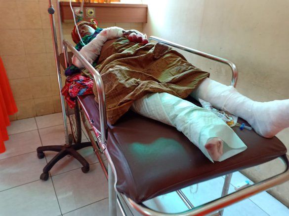 Korban Ledakan Petasan Probolinggo Alami Luka Bakar 33 Persen