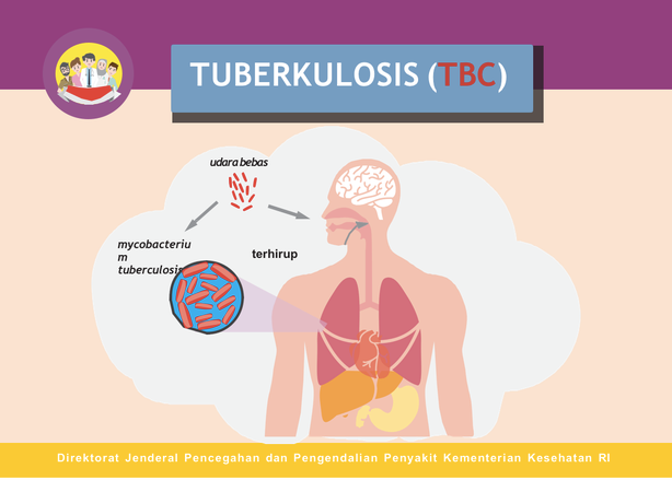 Warga Surabaya Bisa Dapatkan Pengobatan TBC Secara Gratis di Puskesmas dan Rumah Sakit