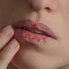 3 Bahan Ini Ampuh untuk Mengatasi Bibir Pecah-pecah