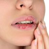 Jangan Disepelekan, Bibir Pecah-pecah Bisa Jadi Tanda Diabetes